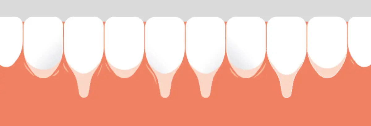 Ilustração das etapas pré e pós gengivoplastia